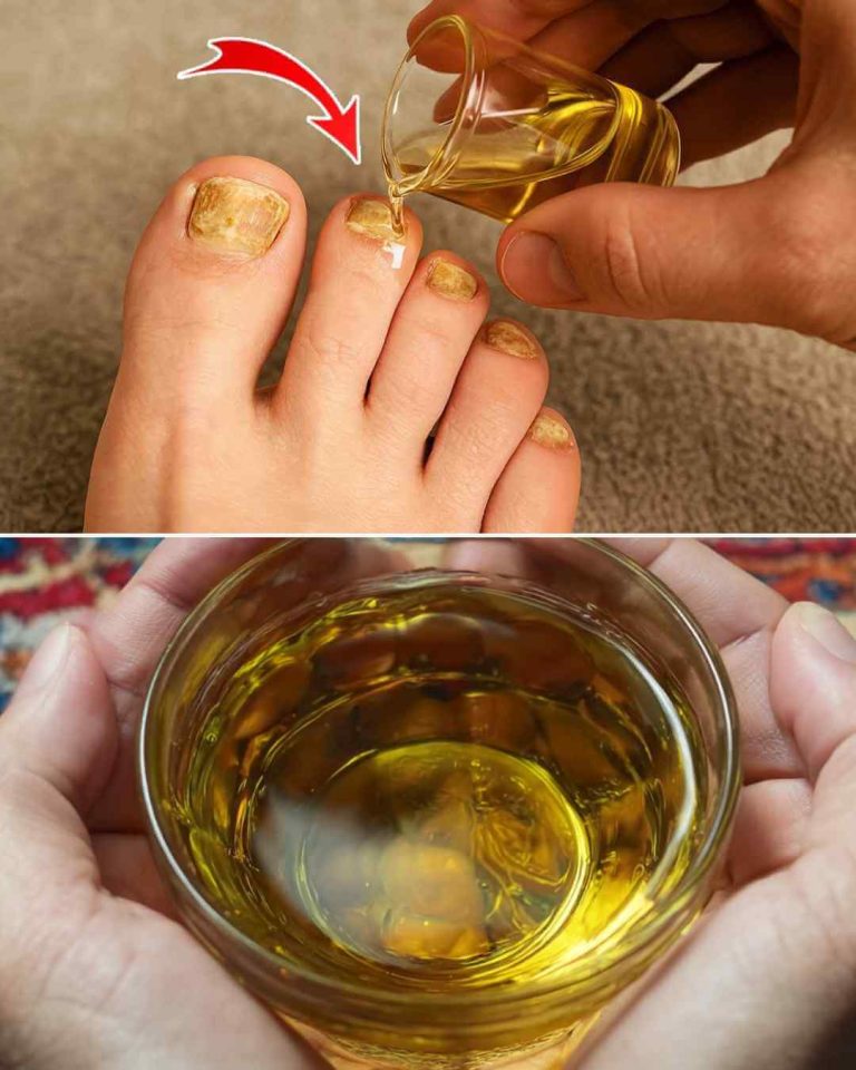 Clove Oil Treatment for Nail Fungus