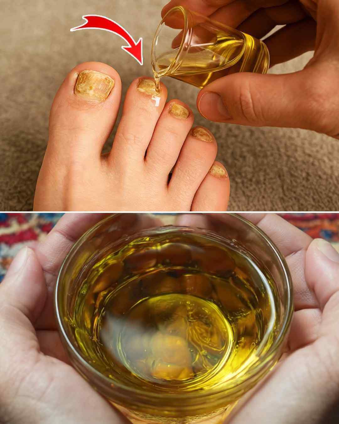 Clove Oil Treatment for Nail Fungus